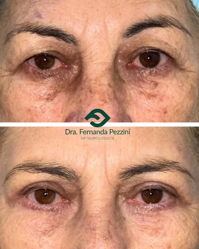 Blefaroplastia: comparação de antes e depois