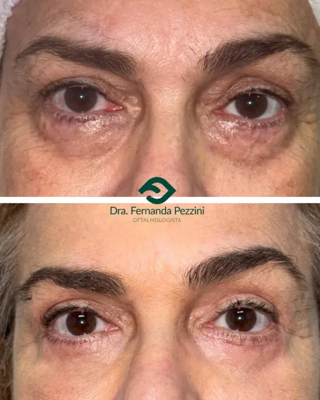 Blefaroplastia: comparação de antes e depois